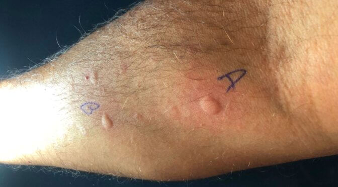 teste alérgico no braço